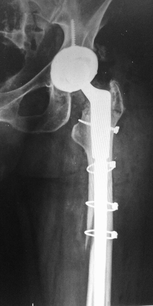 Revision Hip Replacement Orthoelite